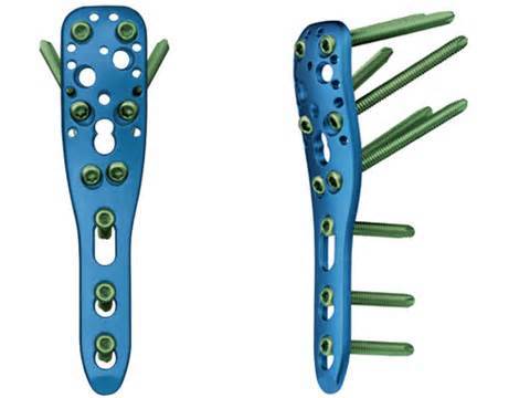 鼎鼎大名的philos肱骨近端钢板了解了这么多骨科钢板的材料学知识
