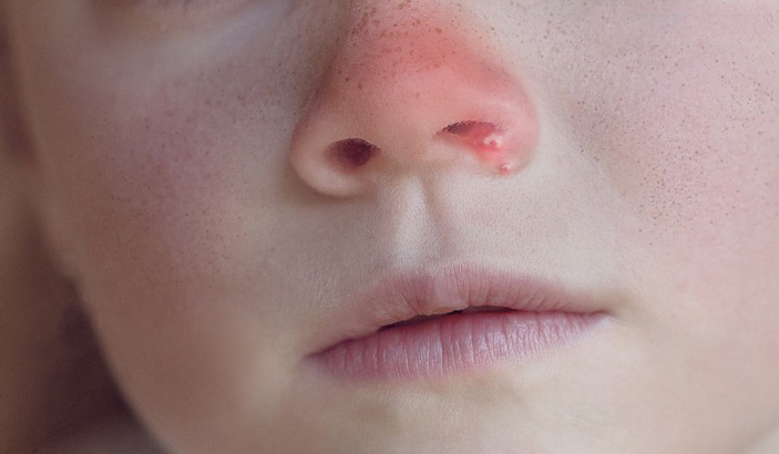 鼻子口疱疹的症状图片图片