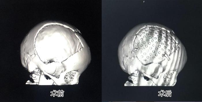经过血肿清除 颅骨修复后,患儿恢复良好手术后,小患儿头颅恢复完好