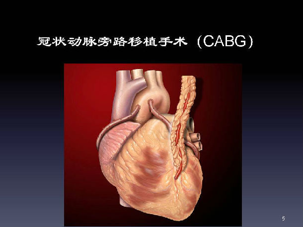 冠状动脉旁路移植术 - 微医(挂号网)