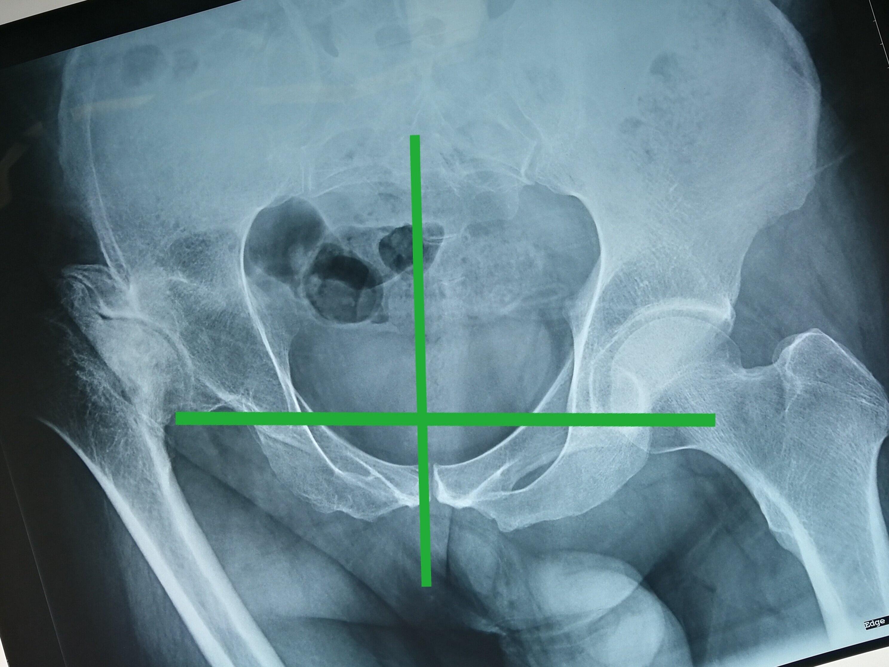 治疗,疼痛跛行逐年加重,本次来就诊时髋关节已经严重屈曲短缩内旋畸形