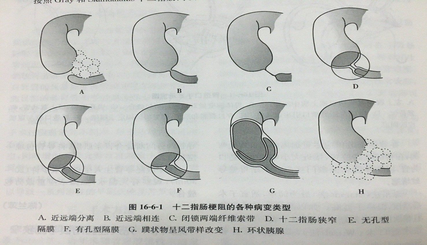 产前发现胎儿双泡征诊断为十二指肠梗阻怎么办
