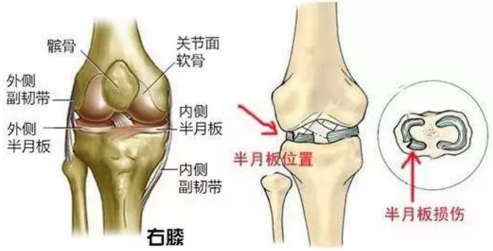 半月板损伤跑步伤到膝盖严重吗