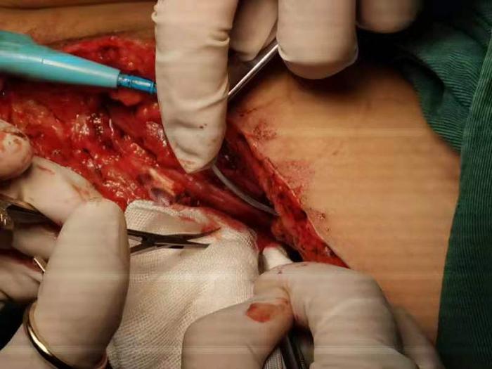 桡神经损伤 - 微医(挂号网)