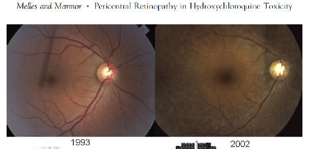 羟氯喹眼毒性的中心周围性视网膜病变和种族差异