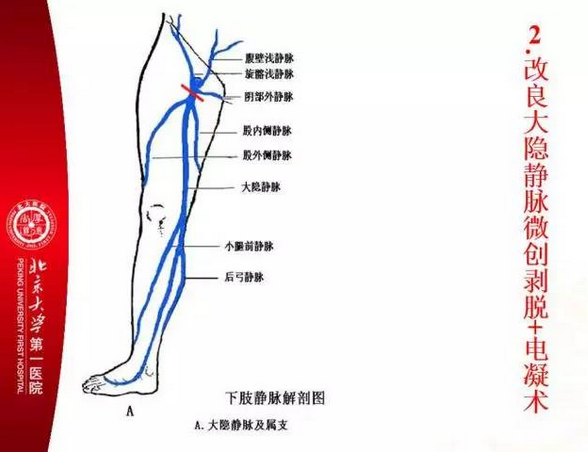 切个1公分的切口,在股内侧静脉和股外侧静脉的上方将大隐静脉结扎
