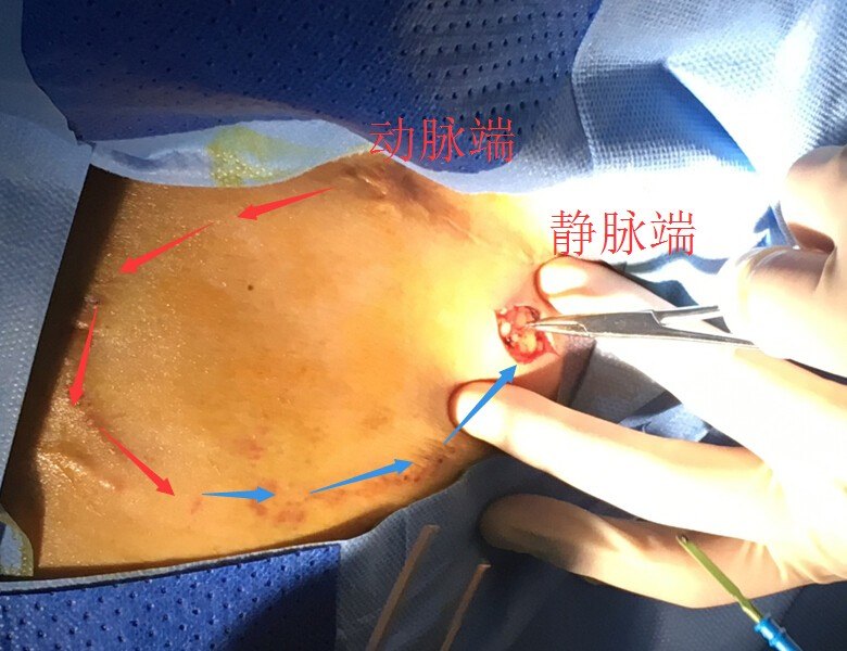 杂交手术治疗血液透析人工血管动静脉瘘血栓
