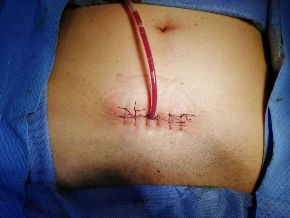 您需要了解的前列腺癌根治手术之单孔前列腺癌根治术