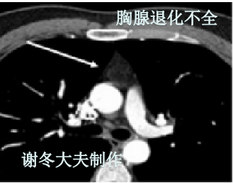 胸腺退化不全是什么意思,ct表现,跟胸腺残留,胸腺增生或胸腺瘤有什么