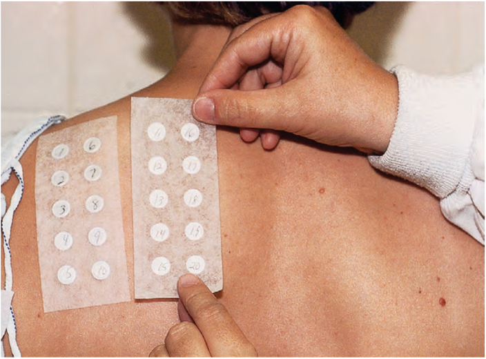 什么是斑贴试验? - 微医(挂号网)