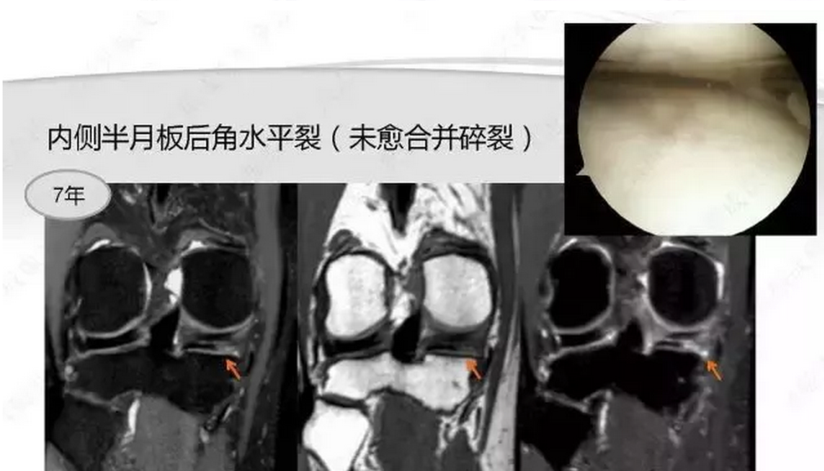 半月板 半月板损伤的mri诊断 健康号 微医
