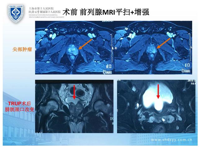 CRPC前列腺癌图片