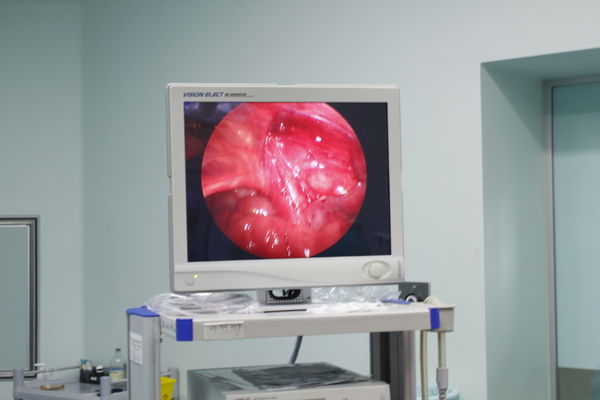 目前我科已经逐步开展隐睾单部位多通道腹腔镜微创手术,即除了阴囊