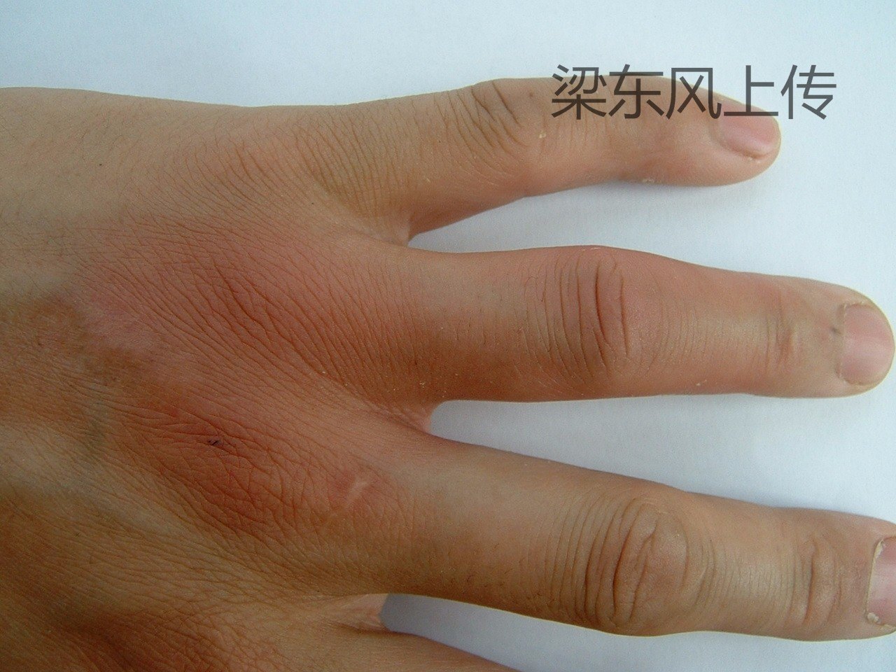 复发性风湿症酷似痛风的发作性关节及软组织肿痛