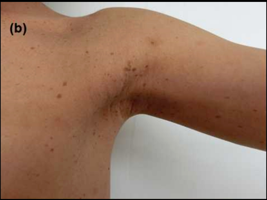 i型神经纤维瘤病介绍及常见问题解答