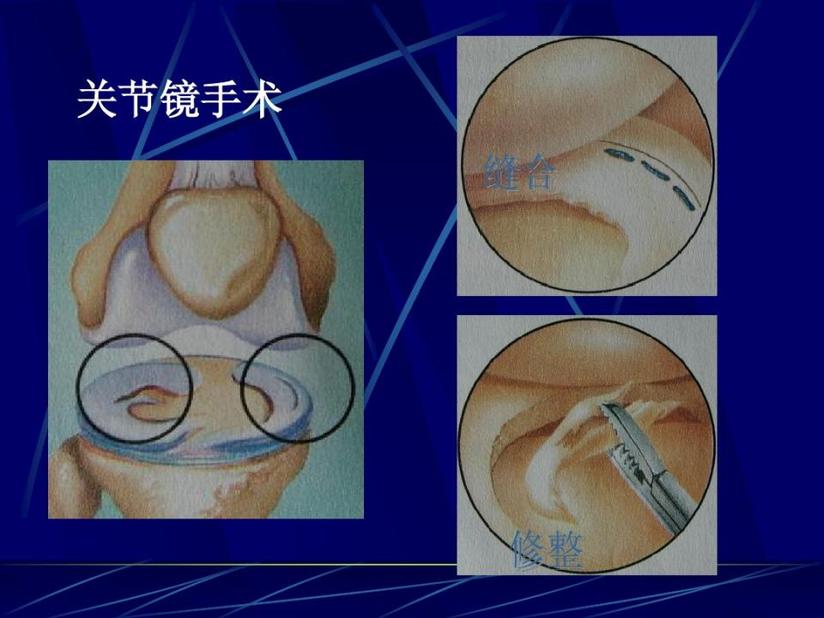 膝关节痛之半月板损伤 健康号 微医