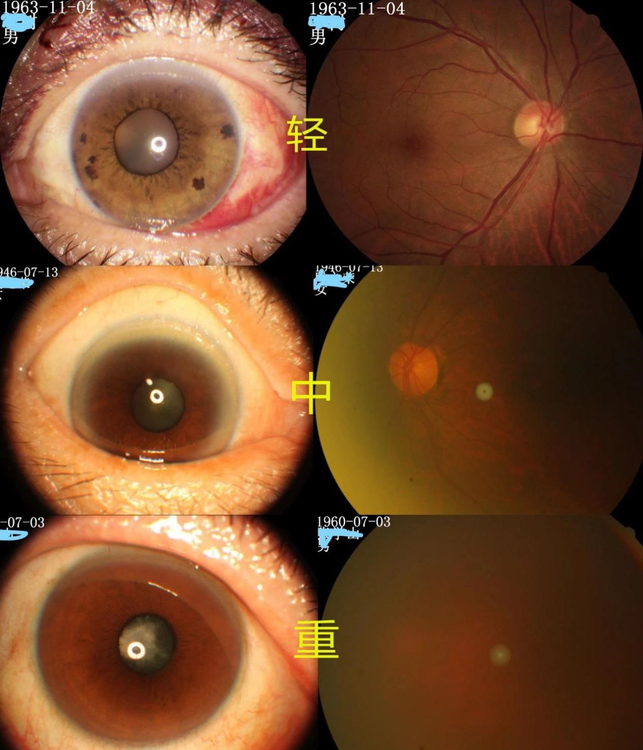 如何判断自己的白内障是在什么程度该不该手术白内障是怎么分期的