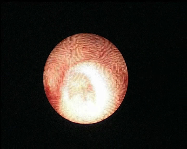 血精精囊炎的最新治疗手段精囊镜技术