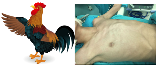 小朋友胸部前凸怎么办啊鸡胸需要手术吗