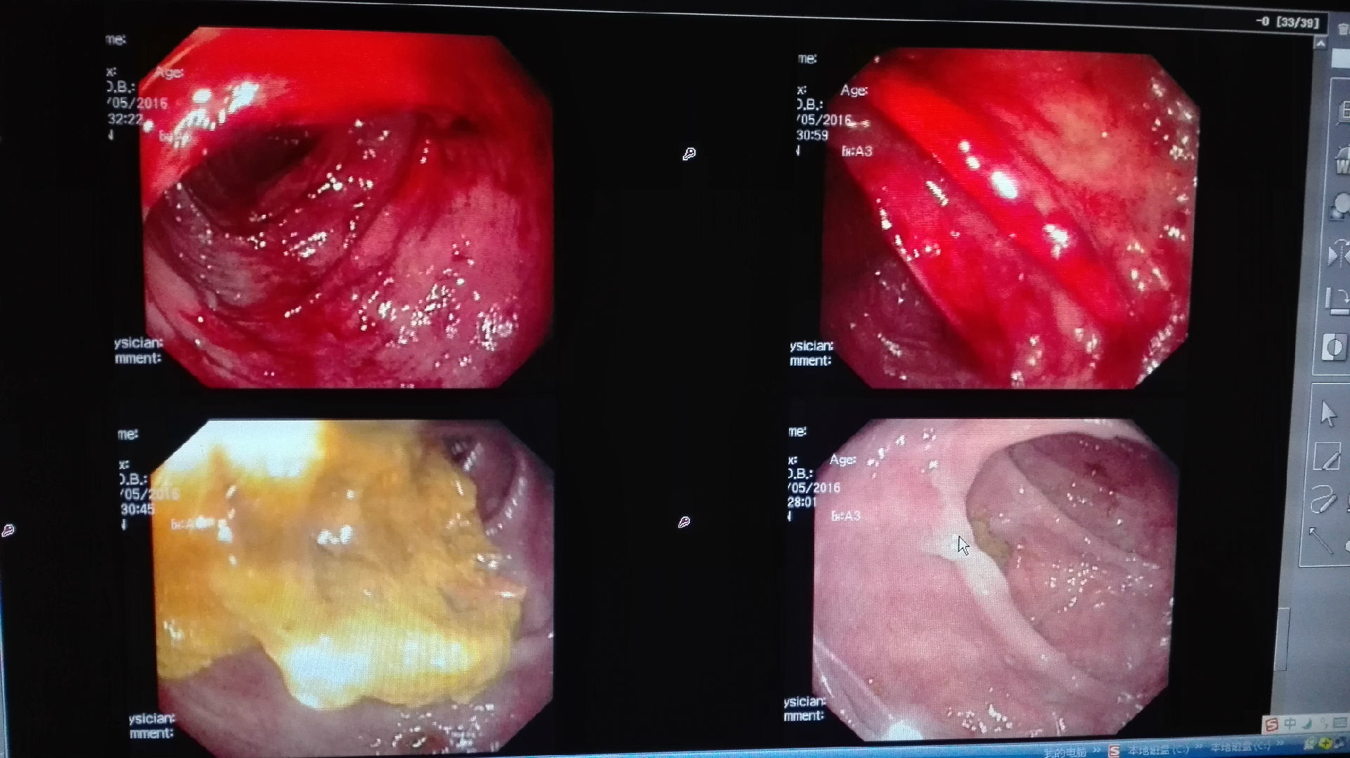 肠道出血是肠道缺血所致--缺血性肠炎2例 - 微医