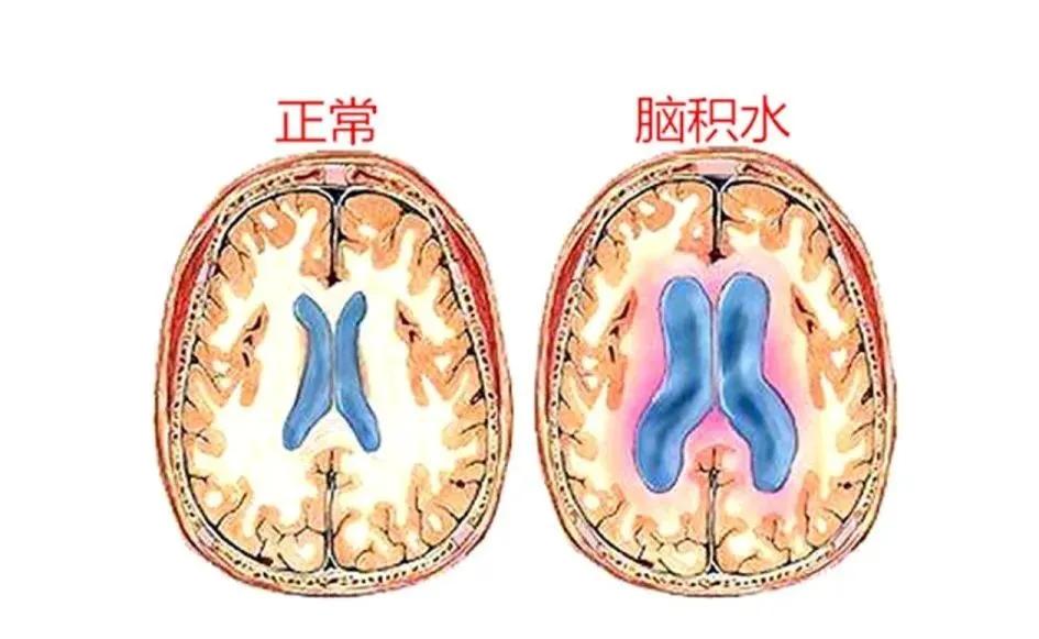 揭秘脑子真的能积水脑积水的水又是哪来的