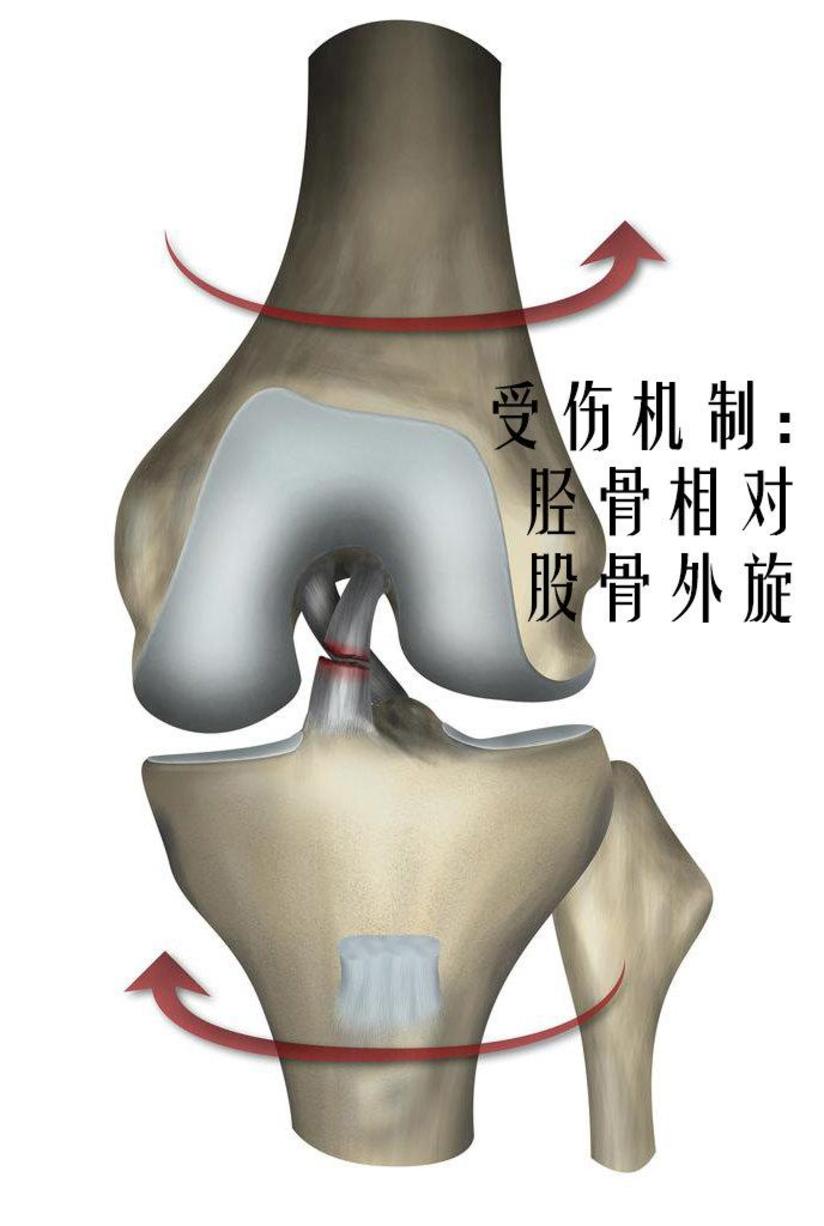前交叉韧带撕裂了该怎么办 健康号 微医