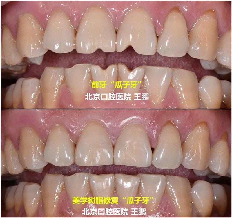 瓜子牙怎么修复