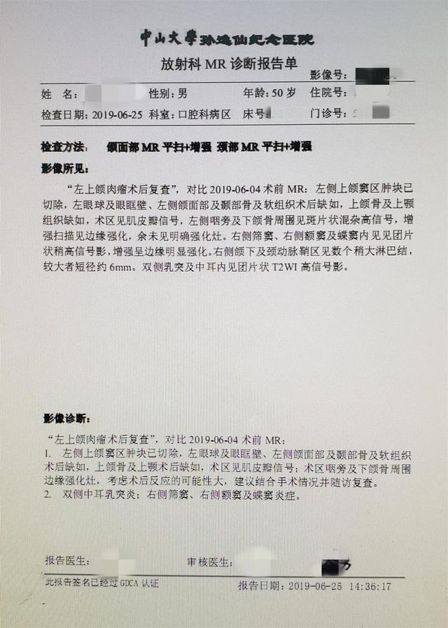 一例鼻咽癌放疗诱导的左上颌颅底骨肉瘤较为棘手的病例