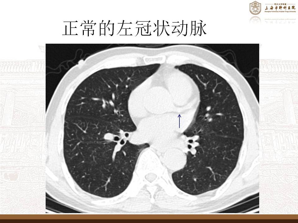 冠状动脉就是给心肌供血的血管,我们常说的冠心病,就是指,这个冠状
