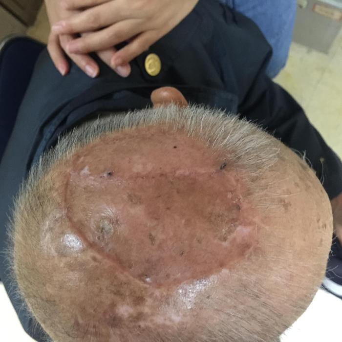 一种皮肤癌2020年11月14日【健康号】王少根