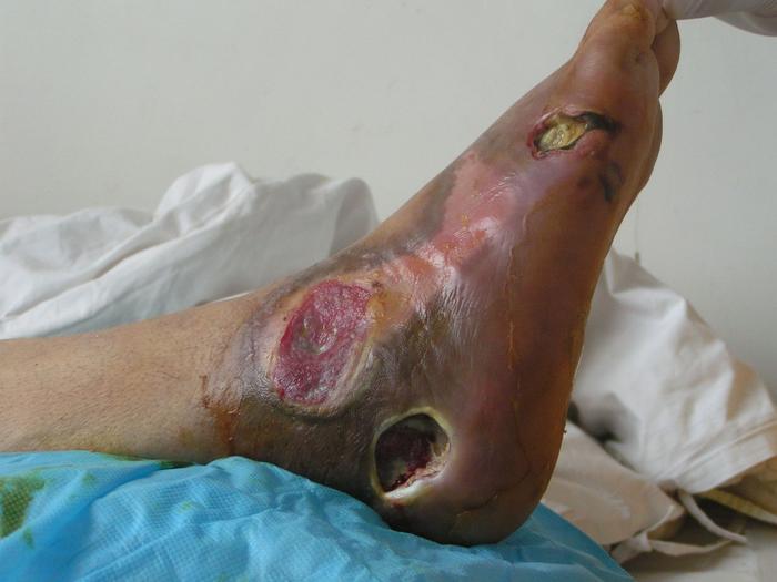 糖尿病足的预防是关键糖尿病患者生活上需要注意哪些呢