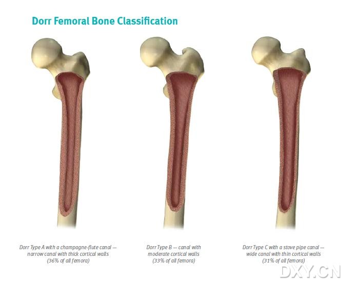 髓腔闪烁指数(canalflareindex)