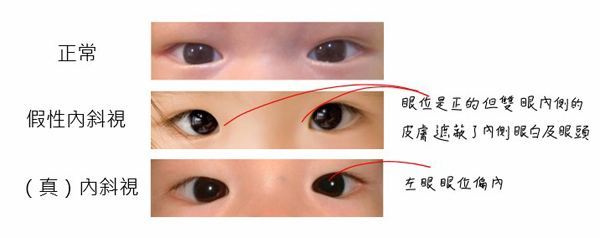 宝宝是不是有斗鸡眼