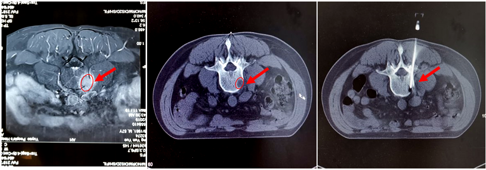 骨转移癌的诊断