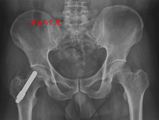 骨小梁金属avn重建棒钽棒治疗早期股骨头坏死