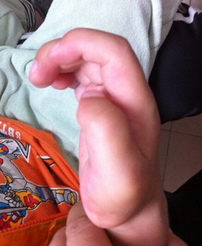 医学科普黏多糖贮积症都有哪些临床表现