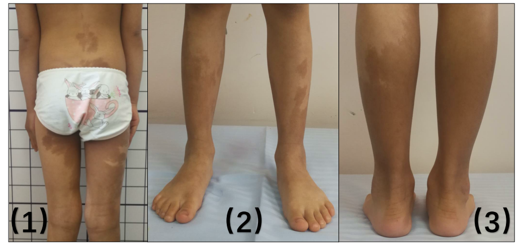 多发性骨纤维结构不良albright综合征