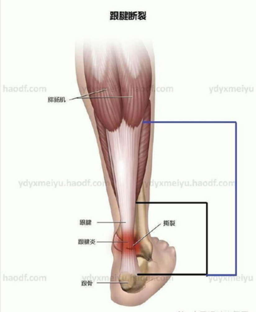 肌腱病 跟腱炎 运动时脚后跟痛该如何是好 健康号 微医