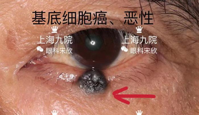 眼皮上奇奇怪怪的疙瘩都是什么?——常见眼睑肿瘤图片(良,恶性)_宋欣