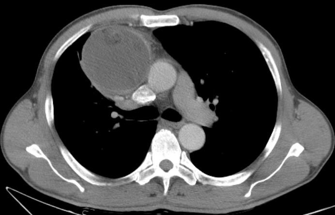 纵隔肿瘤是什么病严重吗一