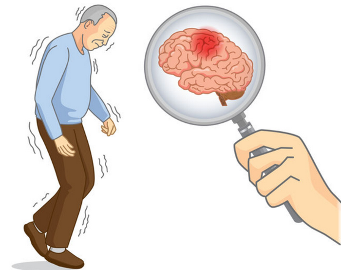 中风120是一种早期发现急性脑卒中的方法:"1"是一张脸,面部可见口角