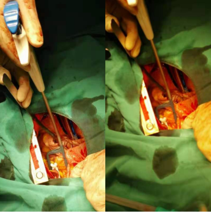 渝西地区首次实施左心耳夹闭术