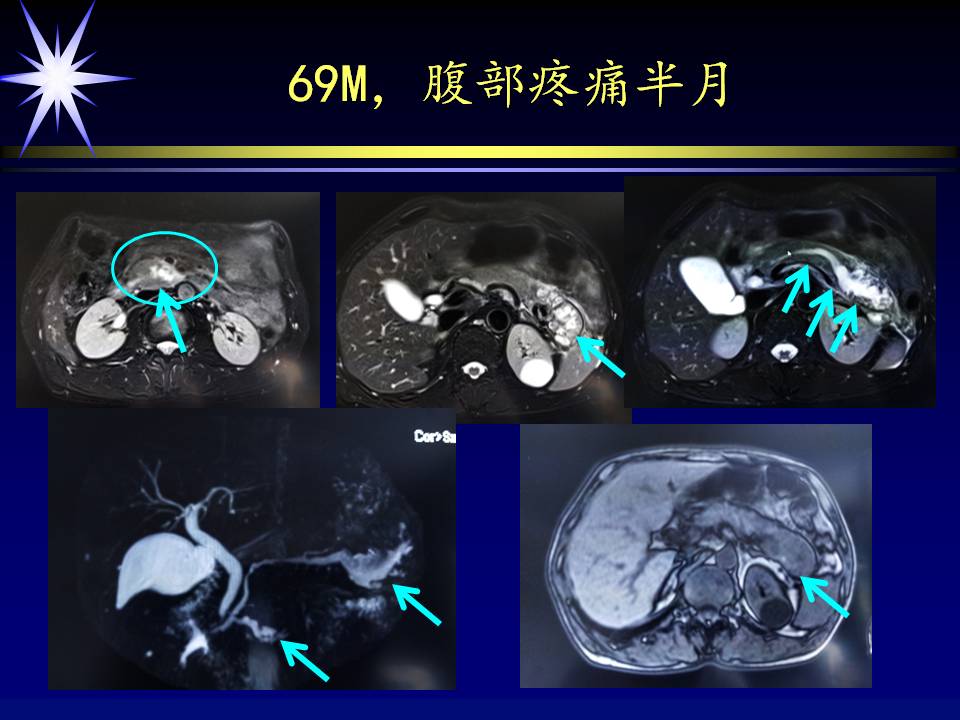 胰腺导管内乳头状黏液性肿瘤的磁共振表现