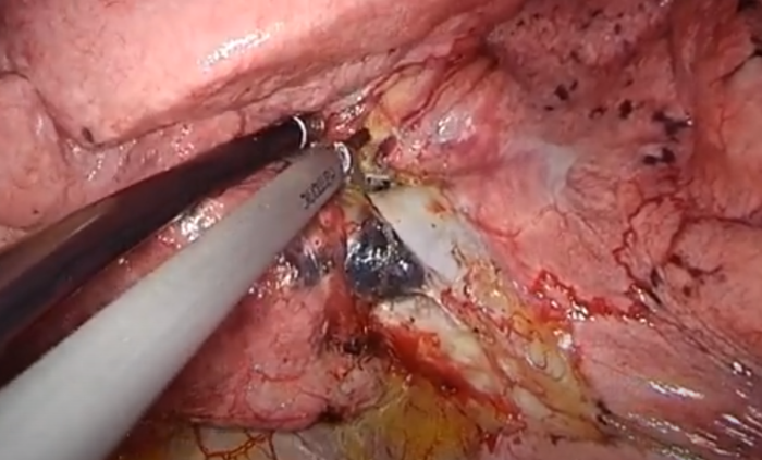 看图说肺胸腔内的淋巴结