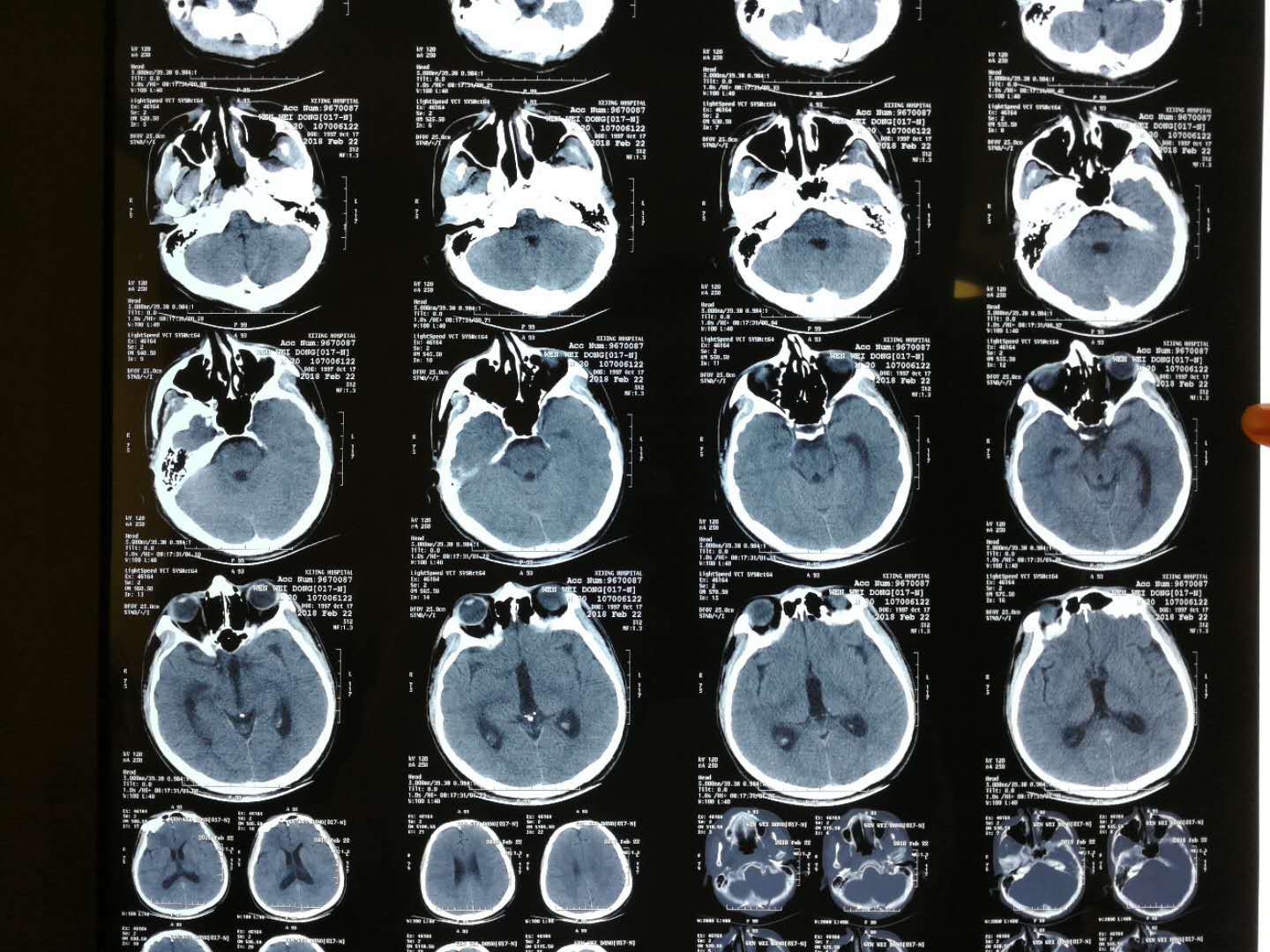 贺晓生教授谈手术四脑室肿瘤手术切除