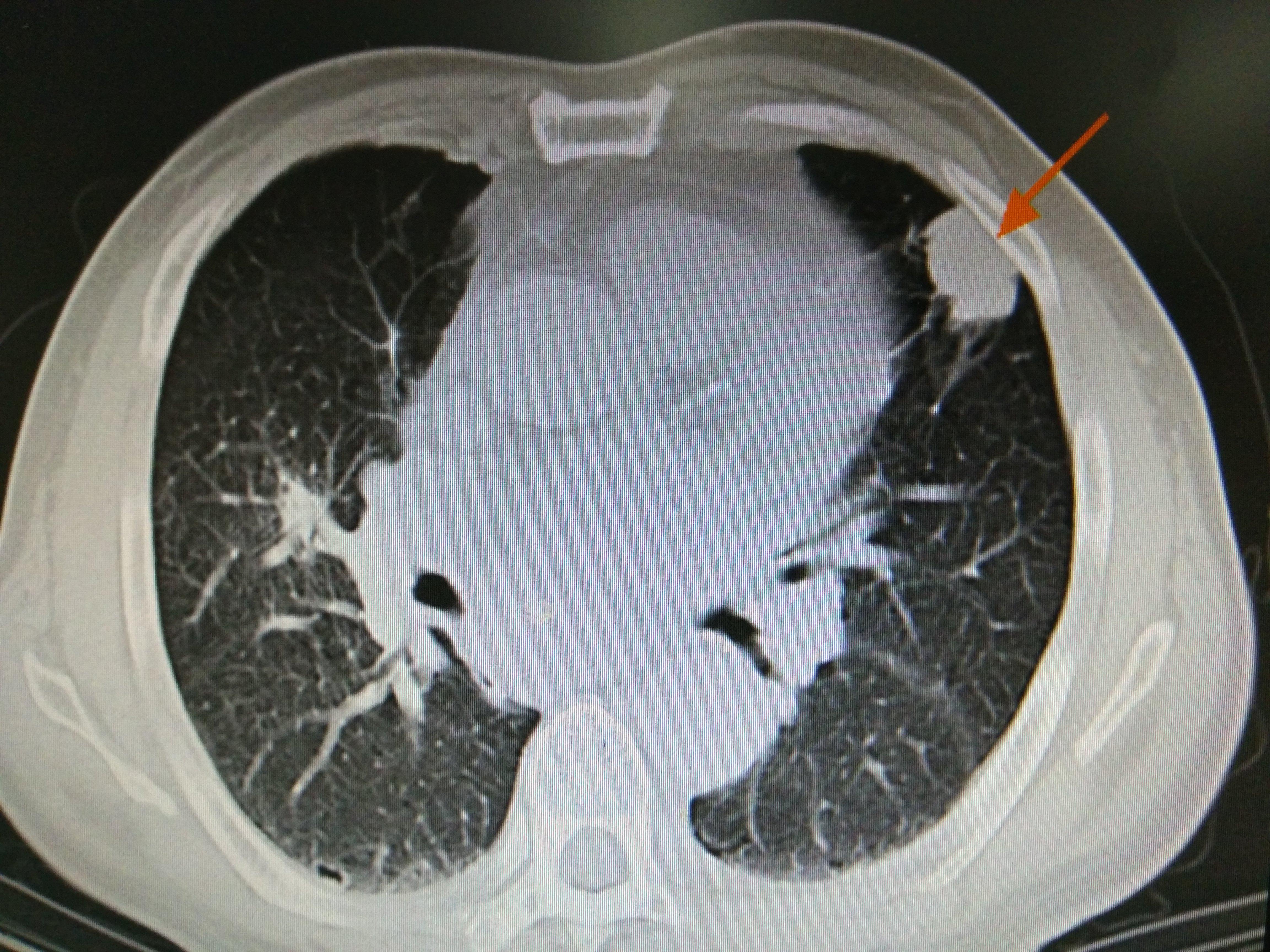 中央型肺癌CT表现，直接征象及间接征象！-健康视频-搜狐视频