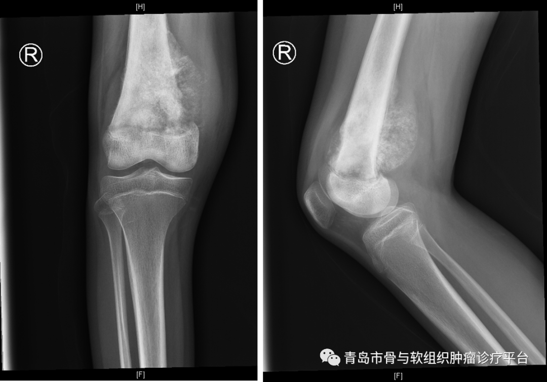 典型病例可延长肿瘤型膝关节假体治疗儿童膝关节股骨远端骨肉瘤