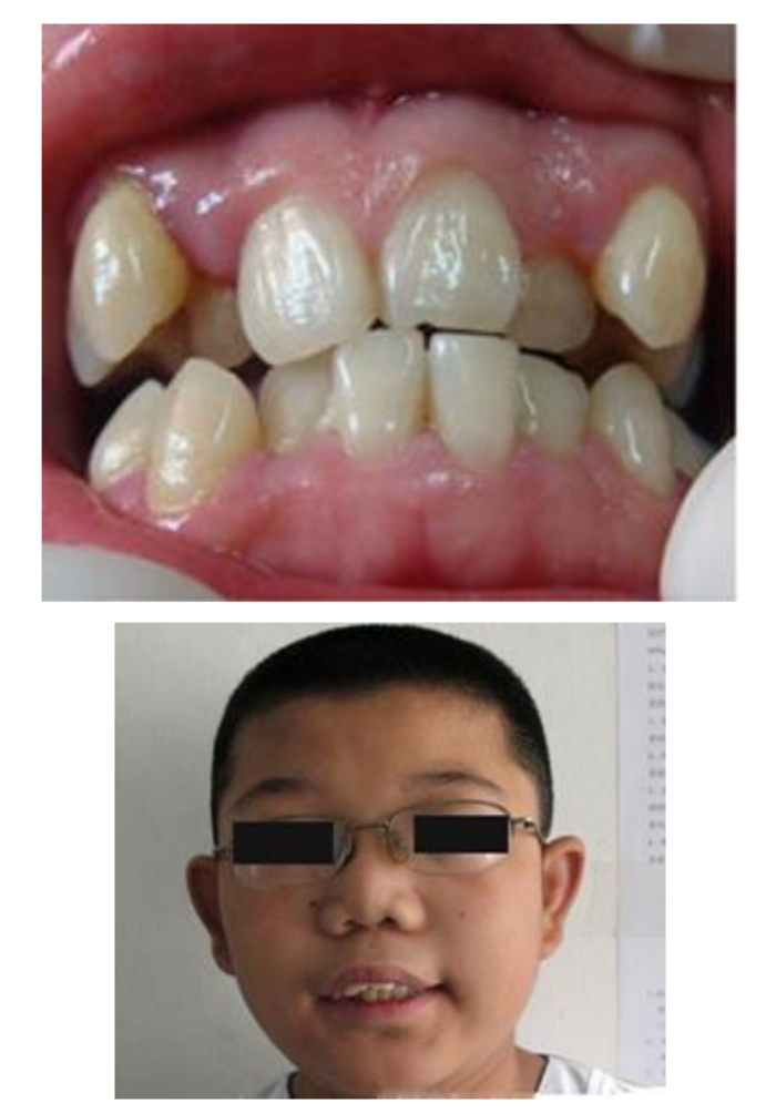 小儿腺样体肥大怎么办?