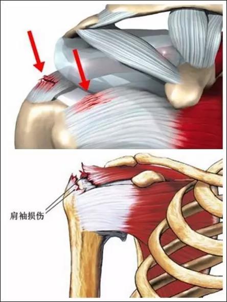 肌腱韧带损伤lars人工韧带与巨大肩袖撕裂
