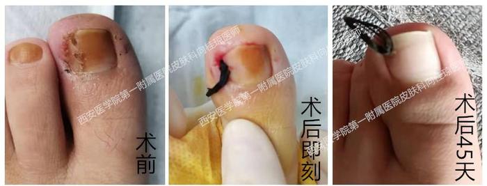 图①:挂线治疗嵌甲性甲沟炎图②:挂线 甲沟重塑治疗嵌甲性甲沟炎